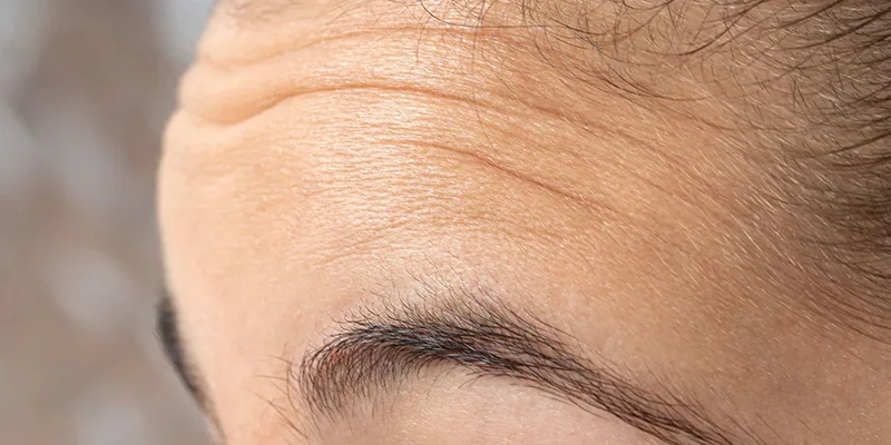 Horizontal Forehead Lines: Causes and Treatments That Work 2 Sun exposure and squinting deepen horizontal forehead lines