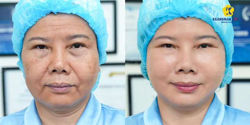 Forehead Wrinkle Treatment in Ho Chi Minh City 6 Reborn Cell Extra+ forehead wrinkle treatment results