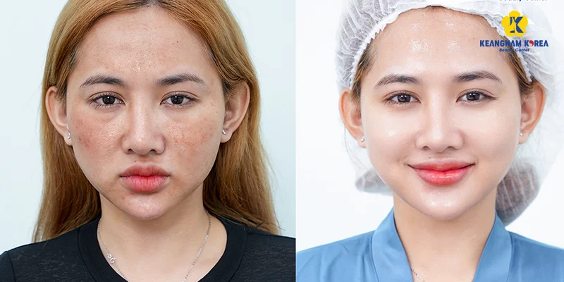 Forehead Wrinkle Treatment in Ho Chi Minh City 4 Needle-free Meso SPI forehead wrinkle treatment
