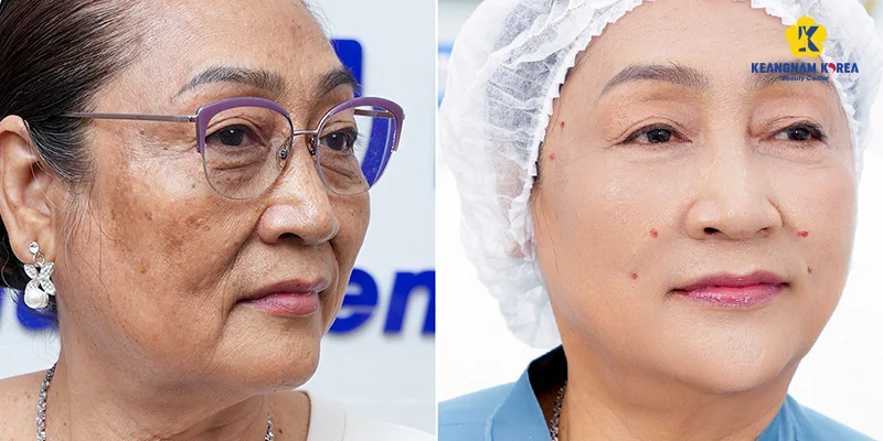 Crow's Feet Treatment: Options That Work and What to Expect 5 Reborn Cell Extra+ crow's feet treatment results